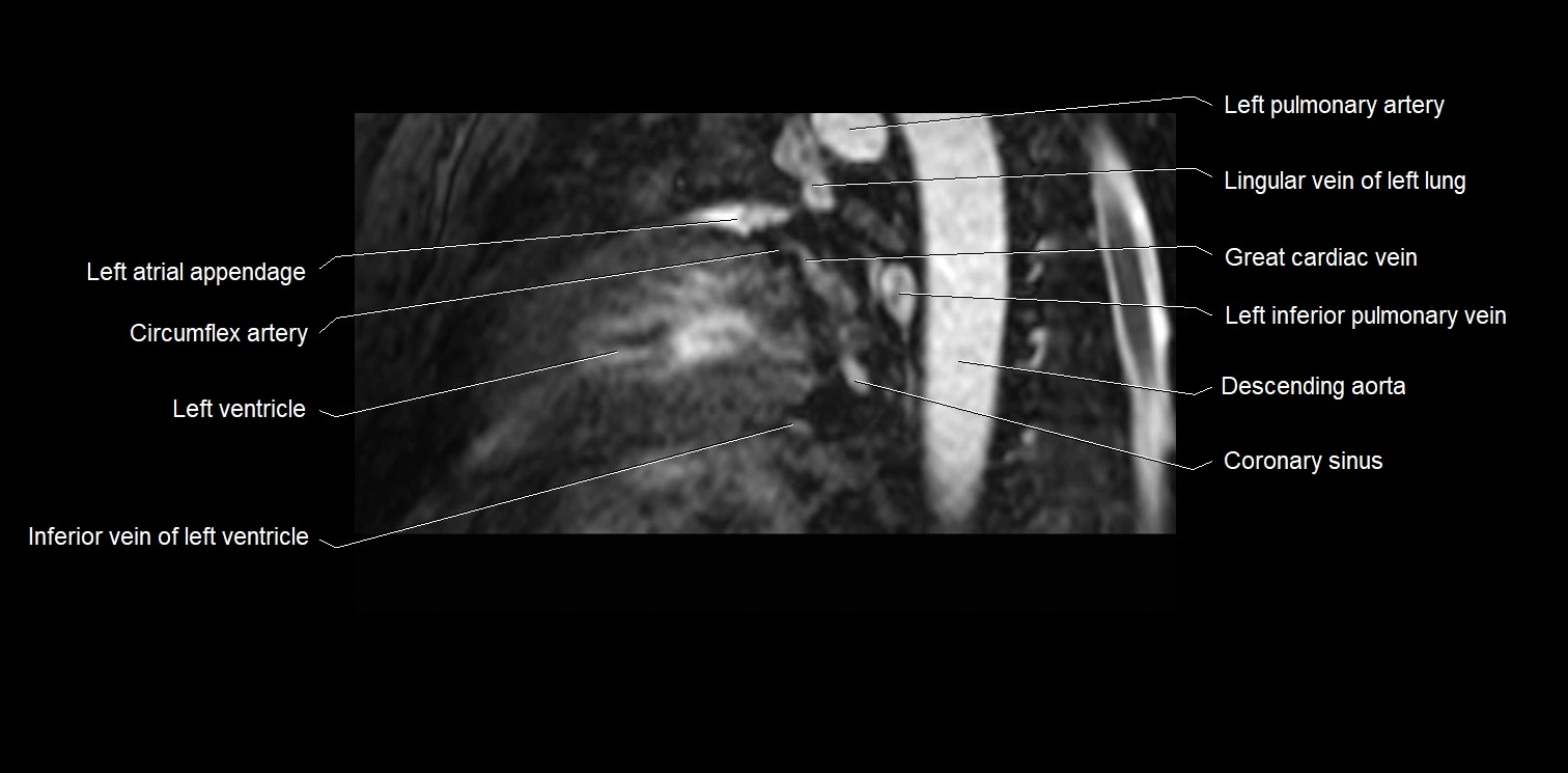 MRI heart and coronary arteries two chamber(sagittal)  anatomy image 34.webp